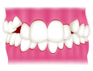 八重歯・乱ぐい歯・ガタガタな歯並び