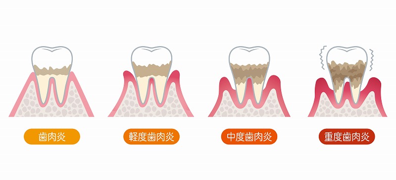 歯周病の進行段階