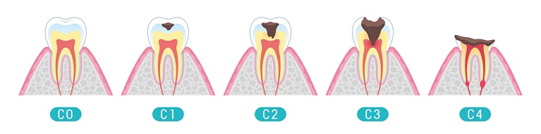 虫歯の進行