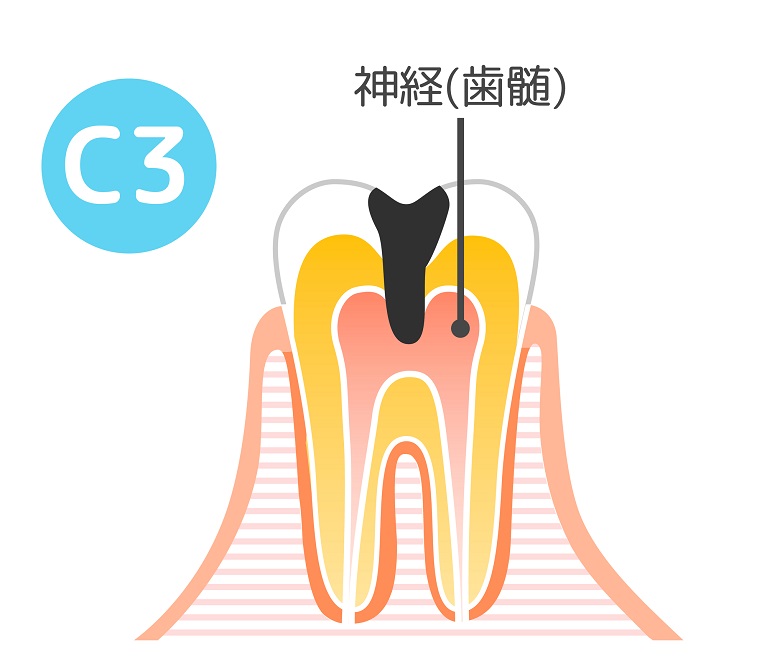 根管治療